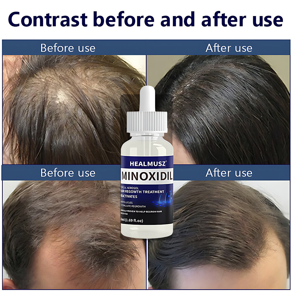 4Pcs Minoxidil 5% Hair Regrowth Treatment Hair Loss &Growth Scalp Liquid For Men