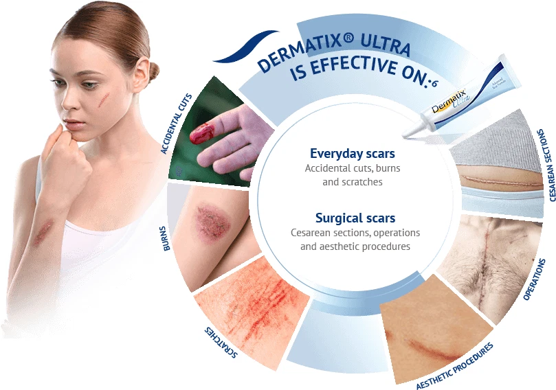 Dermatix Ultra Scar Treatment Gel 15g – Vitamin C & Silicone for Old & New Scars - Image 2 of 4