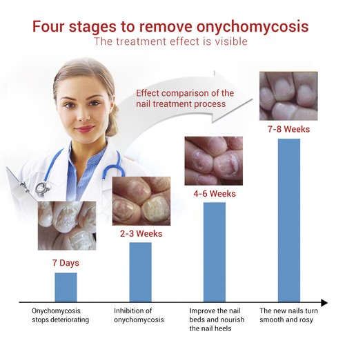 2.LANBENA Nail Repair Essence Remove Onychomycosis Serum Fungal Treatment Toe - Picture 6 of 17