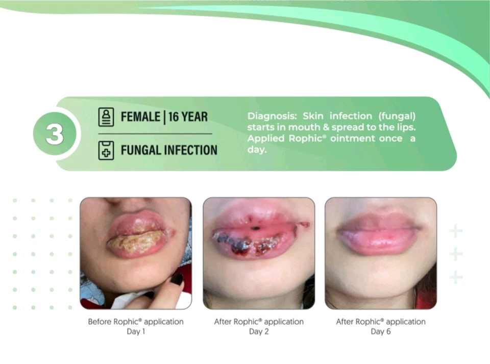 Rophic 软膏 – 皮肤溃疡、烧伤、瘙痒、伤口和湿疹缓解 – 快速愈合 — 第 4/4 张图片