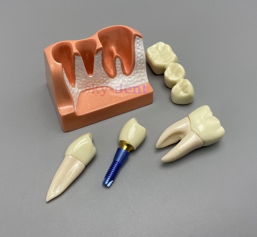 Impianto dentale 4 volte analisi ponte corona dimostrazione denti rimovibili modello - Foto 7 di 7