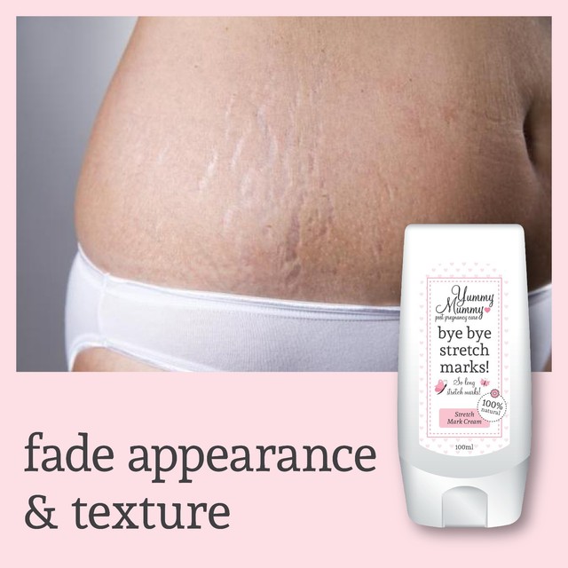 best cream for post pregnancy stretch marks
