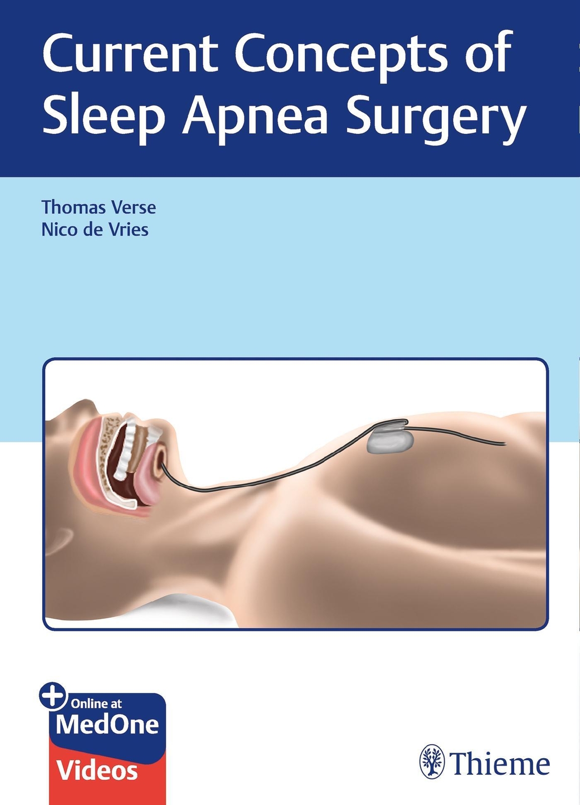 Thumbnail - Current Concepts Of Sleep Apnea Surgery | Thomas Verse (u. A.) |