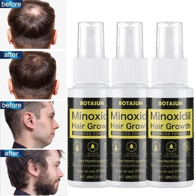 BOTASUN 3 Stück Minoxidil 5% Bart & Haarwachstum Serum Spray für Männer 3 Monats-Vorrat