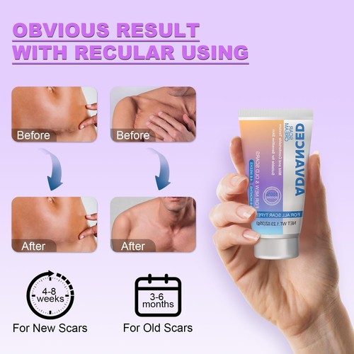 Silicone Scar Cream Scar Gel - Advanced Scar Treatment Keloid Bump Removal fo... - Picture 6 of 6