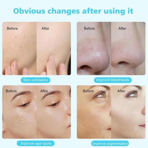 New Skin Rejuvenation Vacuum Microdermabrasion Machine Facial Peel Spot Removal - Picture 7 of 12