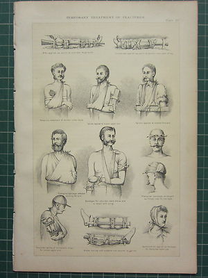 1890 Aufdruck ~ Anatomie Temporäre Behandlung Frakturen Broken Bones Kragen