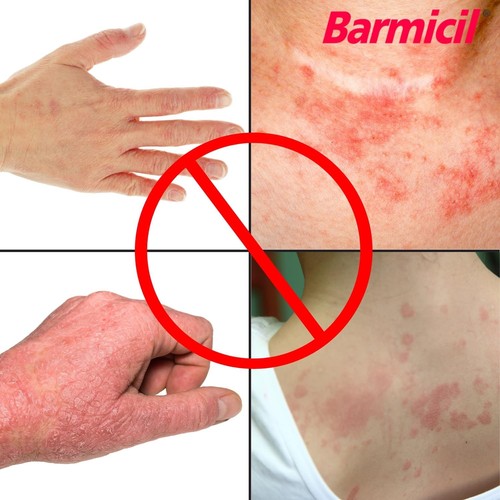 Barmicil Plus Cream w/ Aloe Vera 1% Hydrocortisone Skin Allergies, Anti Itch 1oz - Picture 2 of 9