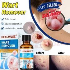 Wart Remover Liquid, Fast Acting to Remove Common and Plantar Warts, Flat Warts