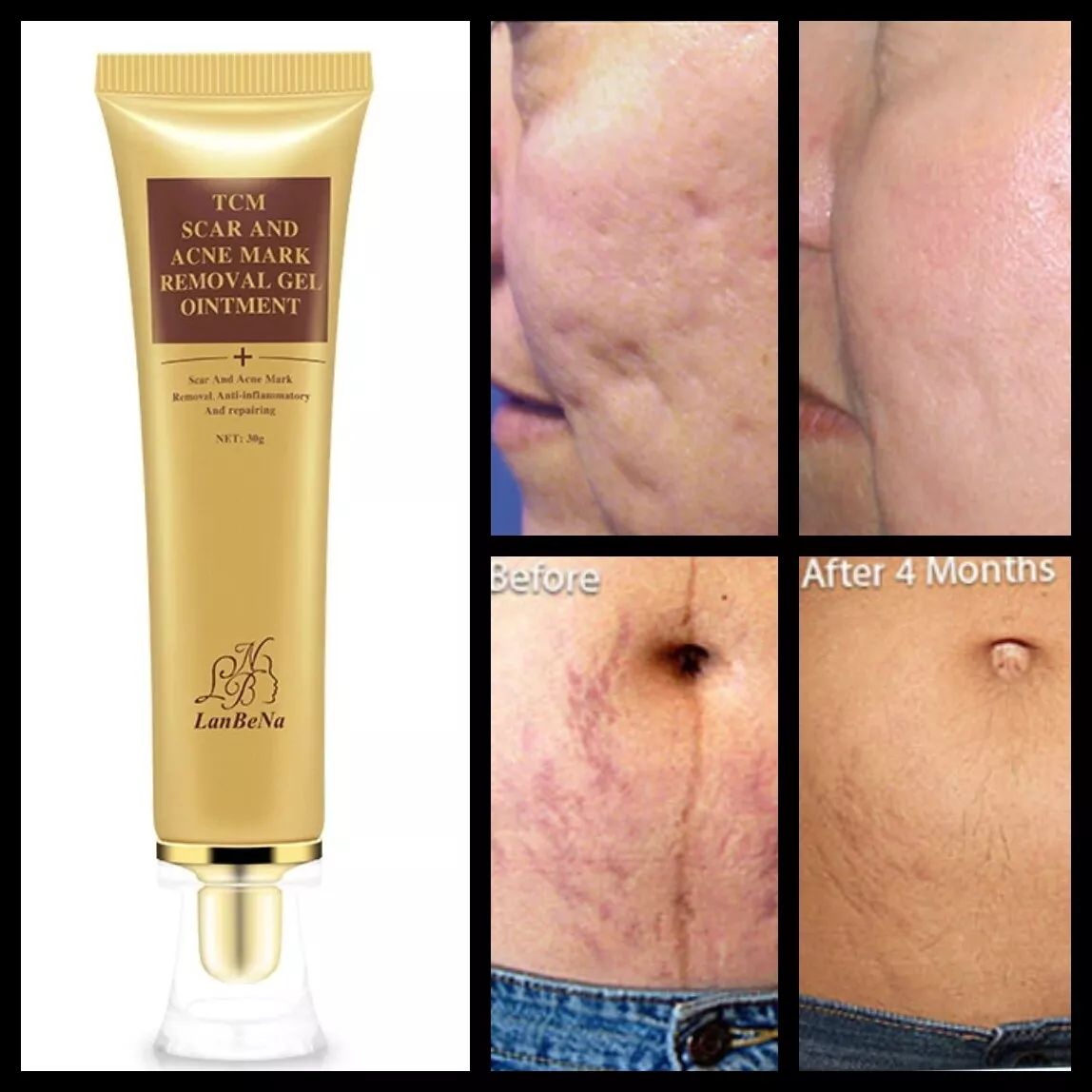 Best Scar removal Cream Skin Care for Scars Reduce Surgery Acne Stretch Marks