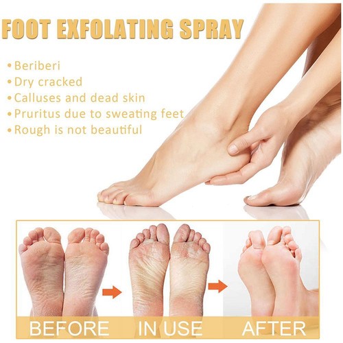 Foot Peeling Spray - Instant Exfoliating Treatment For Dead Alcohol-Free Y2Y4 - Picture 6 of 15