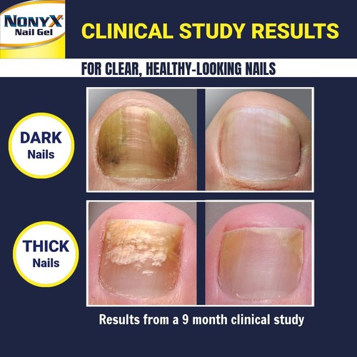 NONYX Nail Clarifying Gel | For Clear, Healthy-Looking Nails | Improves the A... - Picture 4 of 7