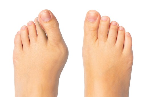 1 Paar Zehen-Distanz-Schiene Zehenspreizer Zehenfehlstellung Hammerzehen Hallux - Bild 6 von 6