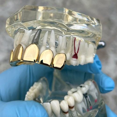 14k Gold Plated Grillz Permanent Cuts Perm Cut Six Top Teeth Pre-Made Grills - 第 4/8 張圖片
