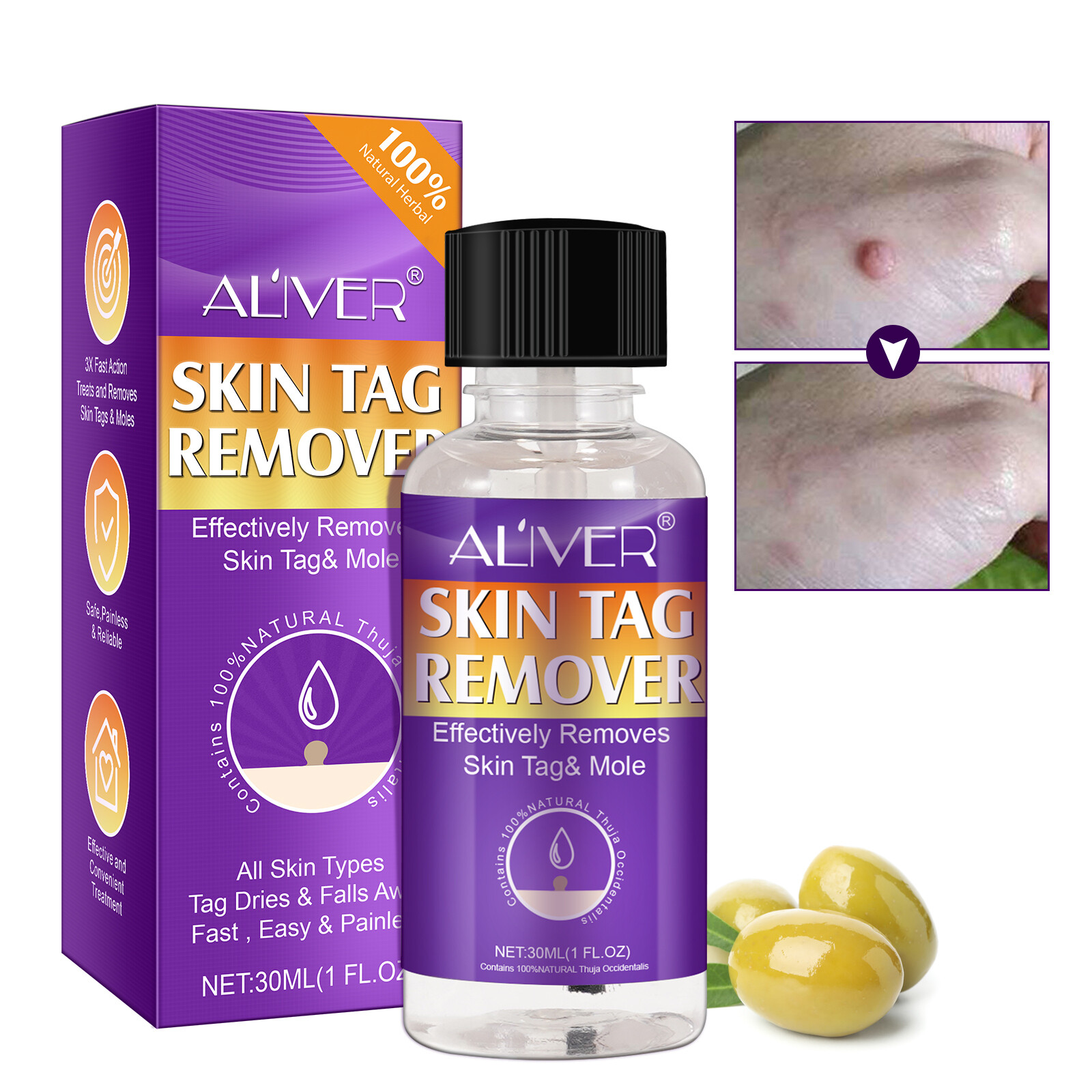 Safe Skin Tag Remover Instant Treatment Fast Wart Acne Removal Body
