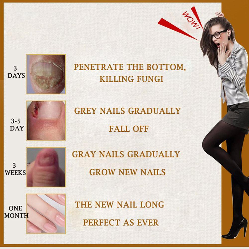 Nail Feet Care Essence Nail Foot Whitening Toe Nail Fungus Removal Gel