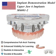 US Full-Arch Implant Restoration Demonstration Model Upper Jaw 6 Implants