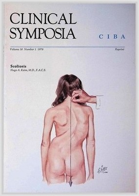 Clinical Symposia: Scoliosis - Netter Art CIBA 1978 - Orthopedic NJ Spine