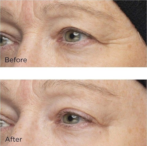 PerriconeMd Cold Plasma Plus by Targeting Improving Appearance Fine Lines - 59ml - Picture 9 of 11