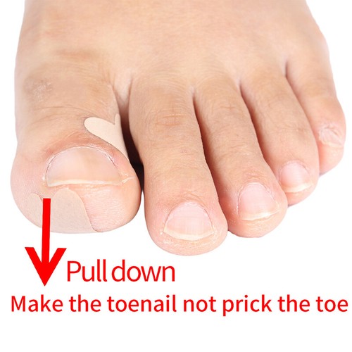 Self Adhesive Ingrown Toenail Corrector Toe Foot Nail Sticker Pedicure Tool US - Picture 8 of 14