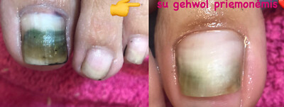 Gehwol Med Anti Fungal Nail Treatment Pen 3ml - Multibuy  