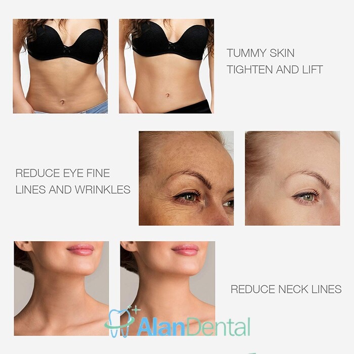 RF Radio Frequency Facial And Body Skin Tightening Machine