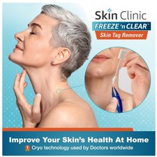 Skin Tag Cryogenic Kit - -Cleared Solution