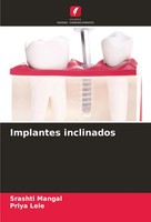 Srashti Mangal (U. A.) | Implantes Inclinados | Taschenbuch | Portugiesisch