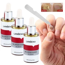 5x LANBENA Nail Repair Essence Remove Onychomycosis Serum Fungal Nail Treatment
