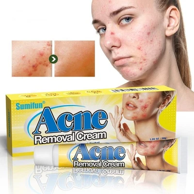 Akne-Reparaturcreme gegen Pickel, Mitesser und Akne-Salbe gegen Akne-Narben - Bild 1 von 4