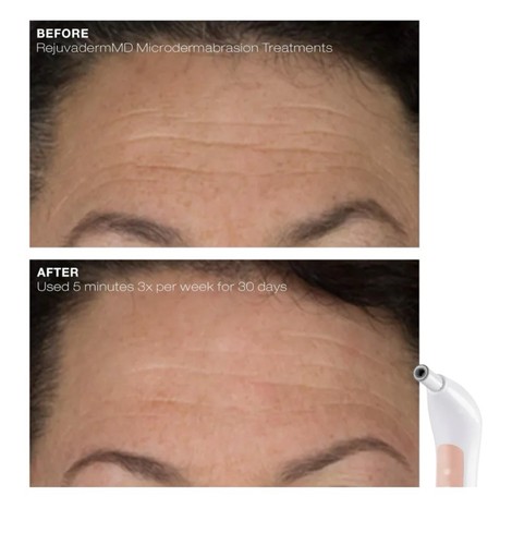 Trophy Skin RejuvadermMD Professional Grade Microdermabrasion System NEW IN BOX - Picture 3 of 7