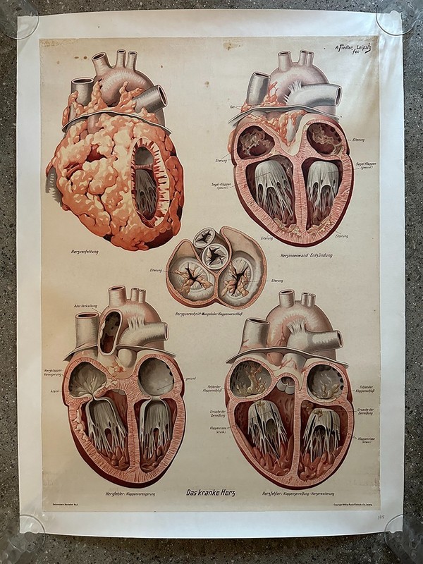 Original vintage 1918 german medical school chart of The Diseased Heart Large