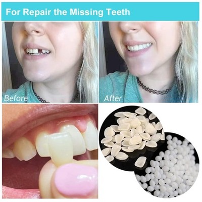 Tooth Gap Filler Set with False Teeth Model - Easy Smile Fix