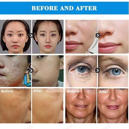 3 In1 Ultrasonic Lifting SKIN Beauty Face Whitening Anti Aging Machine - Bild 9 von 14