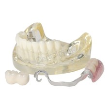 Dental Typodont Restoration Model With 2 Implants Partial Denture Demo