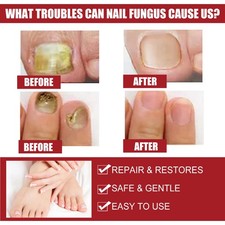 Nail Fungus Treatment Liquid with Moisturizing Formula for Toenail Health