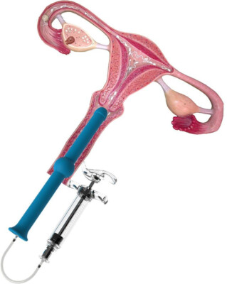 Babymaker Befruchtungshilfe bei Kinderwunsch Insemination, schwanger werden