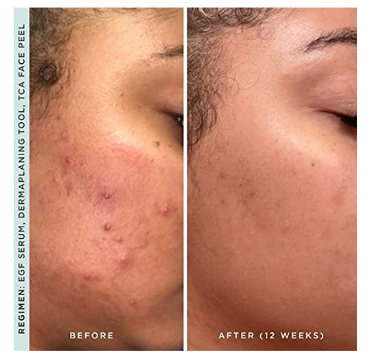Stacked Skincare Activating EGF Serum Hyperpigmentation Skin Care Face Treatment