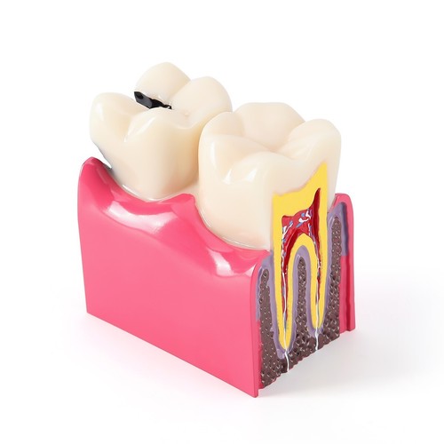 6 Times Dental Caries Tooth Model Decay Teeth Comparative Study Model Teaching - Picture 12 of 19