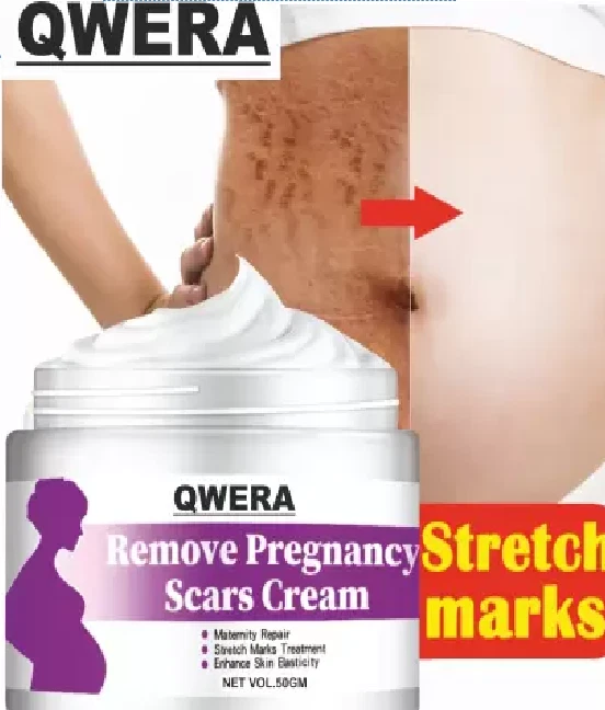 best stretch mark removal