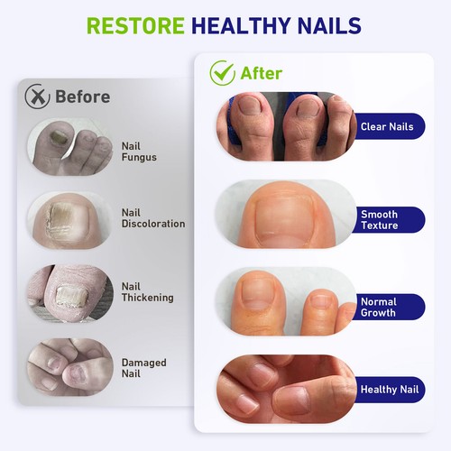 Laser Treatment Device for Nail Fungus Onychomycosis PainFree Fungal Elimination - Picture 3 of 9