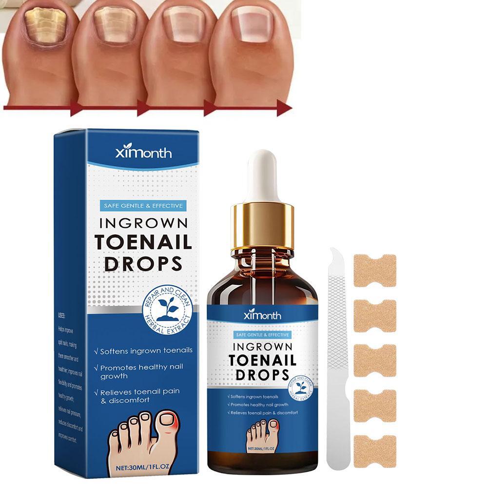 Eingewachsene Zehennagel Behandlung Tropfen 30ml - Natürliche Korrektur Nagelhaut Pflege Öle Heiß