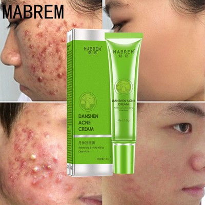acne removal oil control
