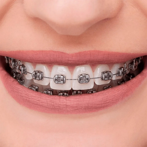 OrthoMetric Advanced Series Metal Bracket Kit - Picture 1 of 14