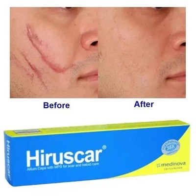5 Tubes X 5G Hiruscar Scar Gel For Treats Keloid, Hypertrophic & Atrophic Scars