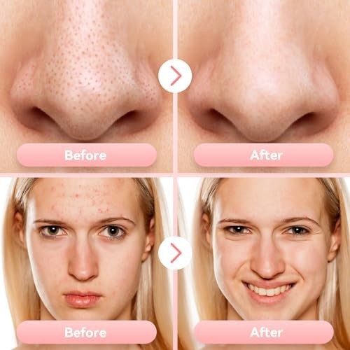 Blackhead Remover Vacuum - Facial Pore Cleaner, 5 Suction Levels & Probes, USB R - Picture 7 of 8
