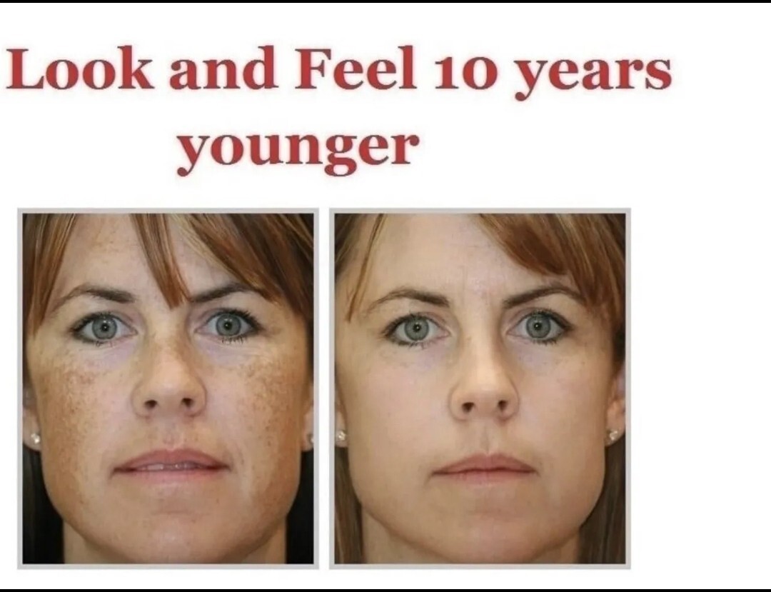 APPOLUS Professional Microderm Device. Diamond Microdermabrasion Facial