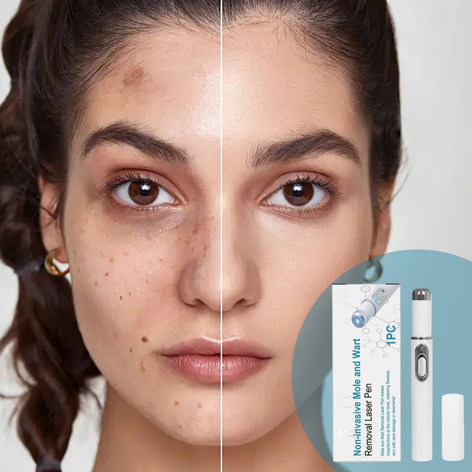 non-invasive-mole-and-wart-removal-laser-pen-advanced-skin-tag-removal