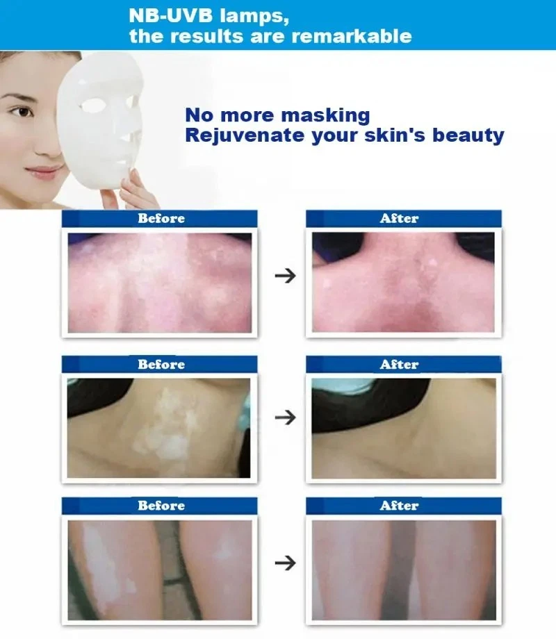 Dispositivo Fototerapia Philips Trattamento Vitiligine Macchie Bianche UVB 311nm - Imagen 4 de 4