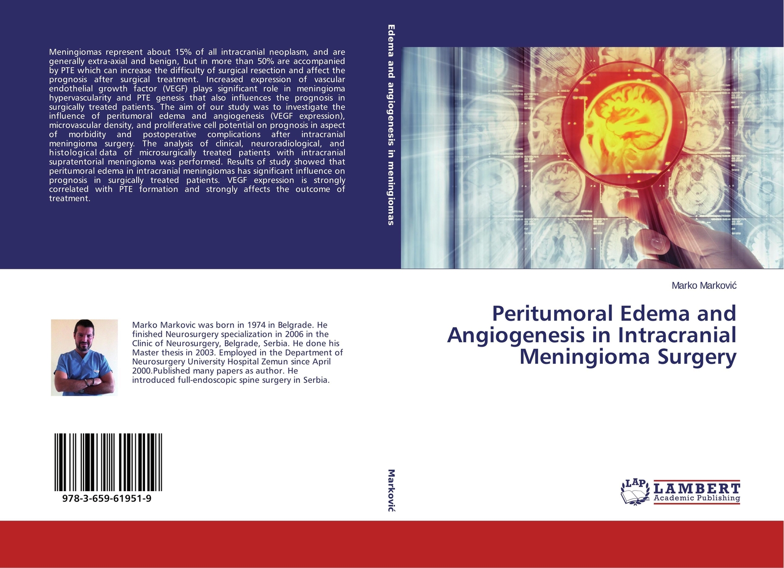 Thumbnail - Peritumoral Edema And Angiogenesis In Intracranial Meningioma Surgery